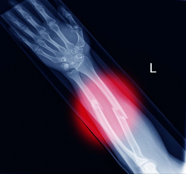 Fractura conminuta